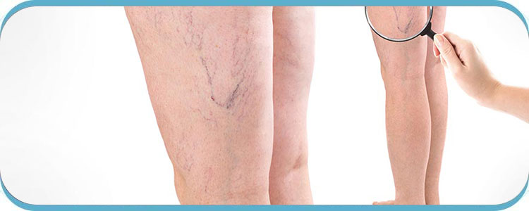 Vein Treatment Specialist Near Me in Henderson NV Vein Treatment Specialist Near Me in Henderson NV