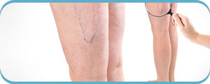 Vein Treatment Specialist Near Me in Henderson NV Vein Treatment Specialist Near Me in Henderson NV