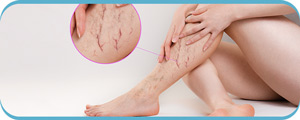 Rediscover Your Comfort: Advanced Vein Solutions for Every Step in Henderson, NV Rediscover Your Comfort: Advanced Vein Solutions for Every Step in Henderson, NV